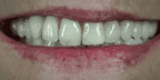 NovaBright Snap On Veneers For Upper And Lower Teeth Instant Natural Smile 2