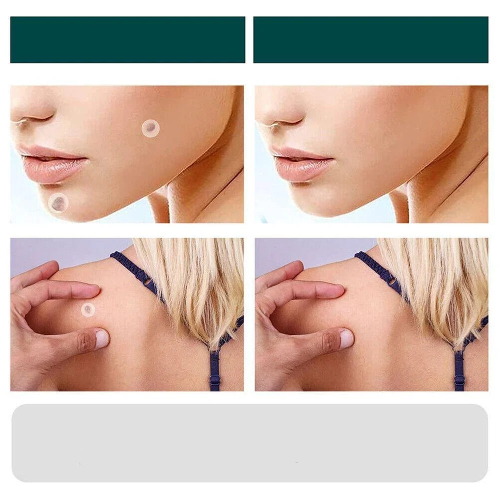 SkinClear - Patch for the removal of spots and warts Kalsten 5